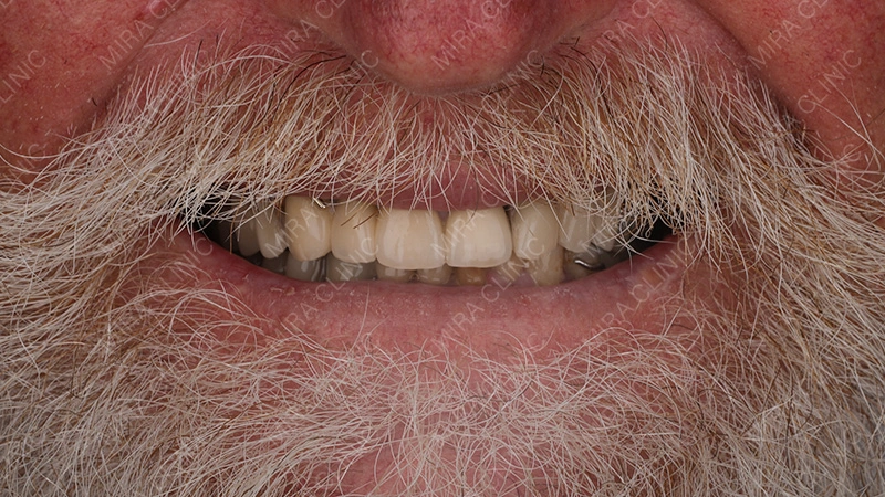 full smile makeover using dental implants